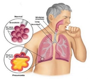 Types Of Pneumonia – Answers To All Types Of Questions | TypesOf.com